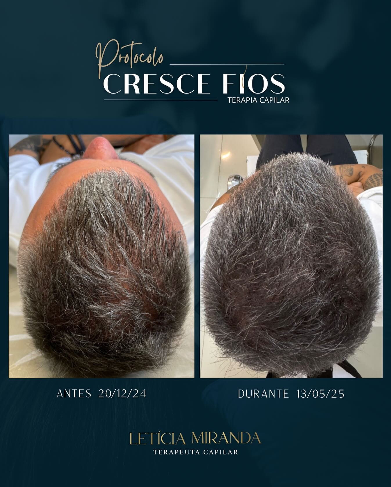 Antes e depois de tratamento capilar masculino
