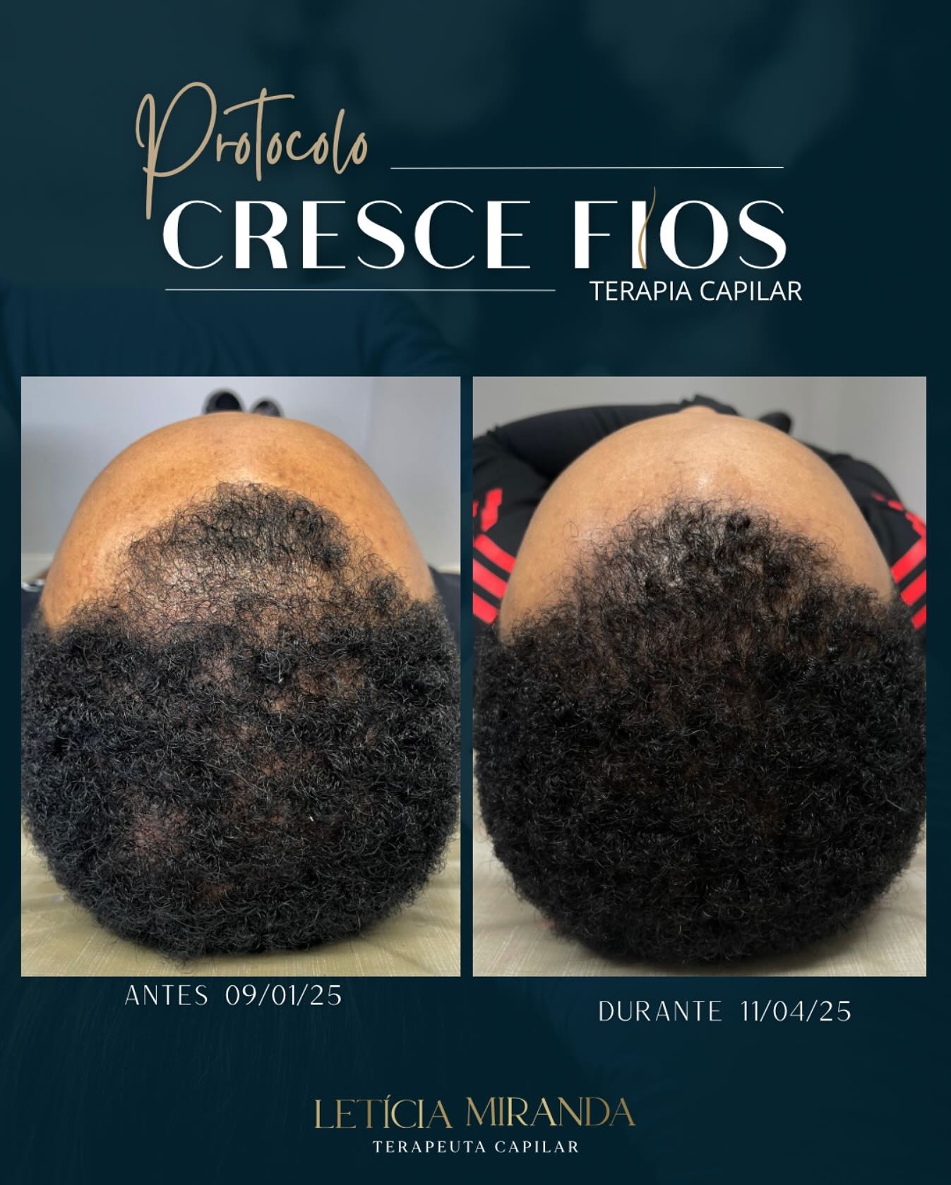 Protocolo Cresce Fios — antes e depois calvície masculina