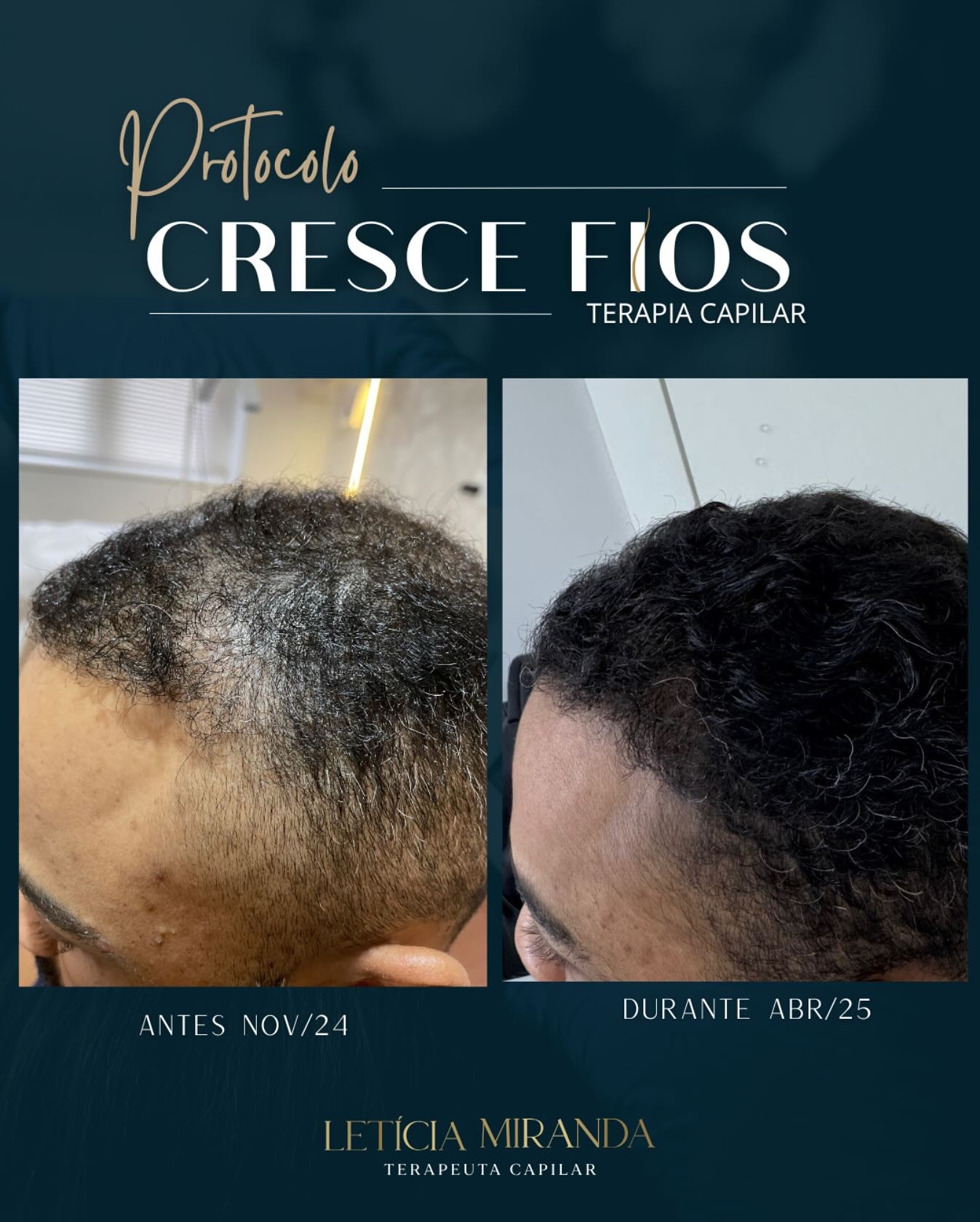 Recuperação de entradas capilares masculinas